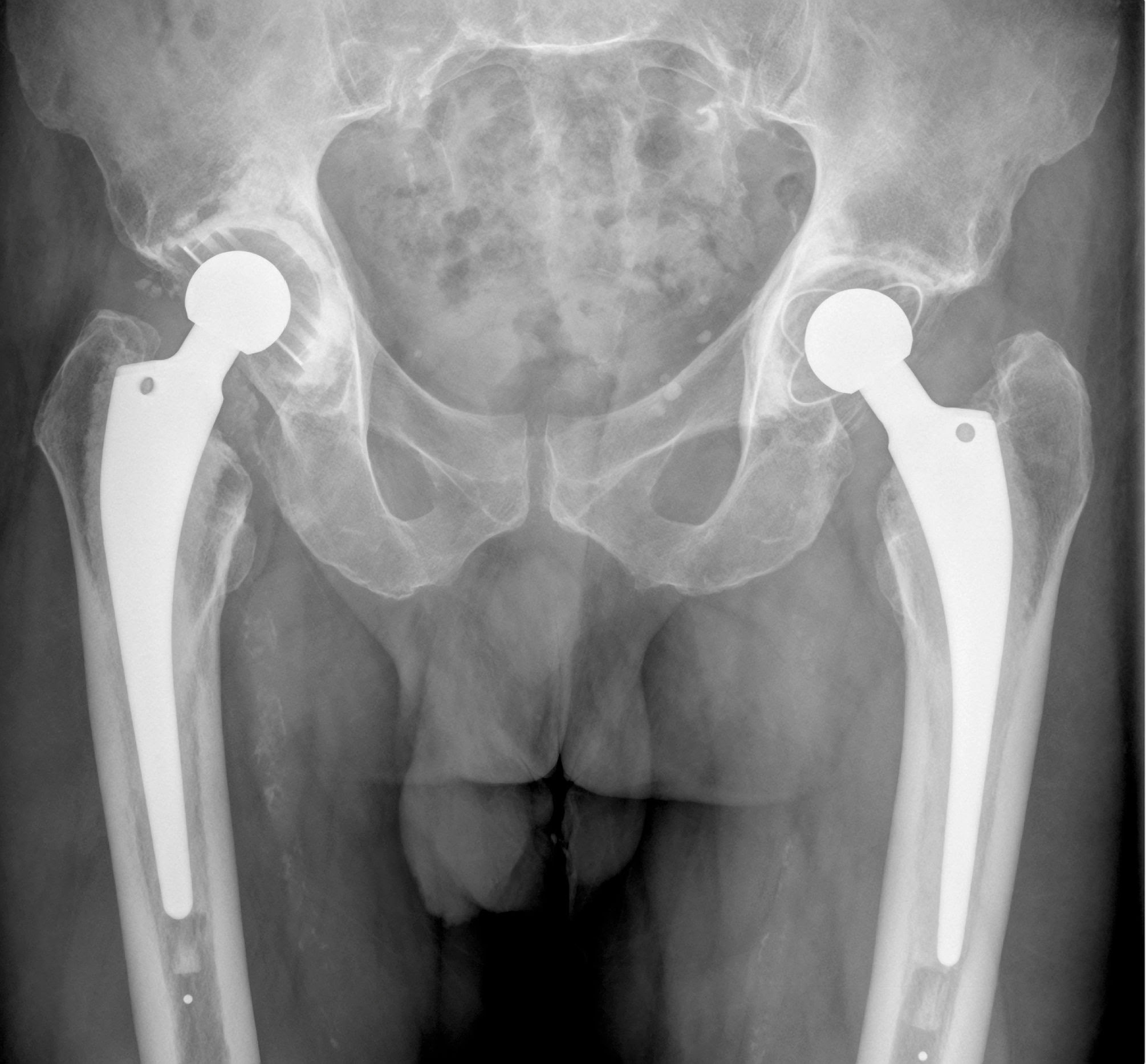 hip-replacement-surgery-in-lahore